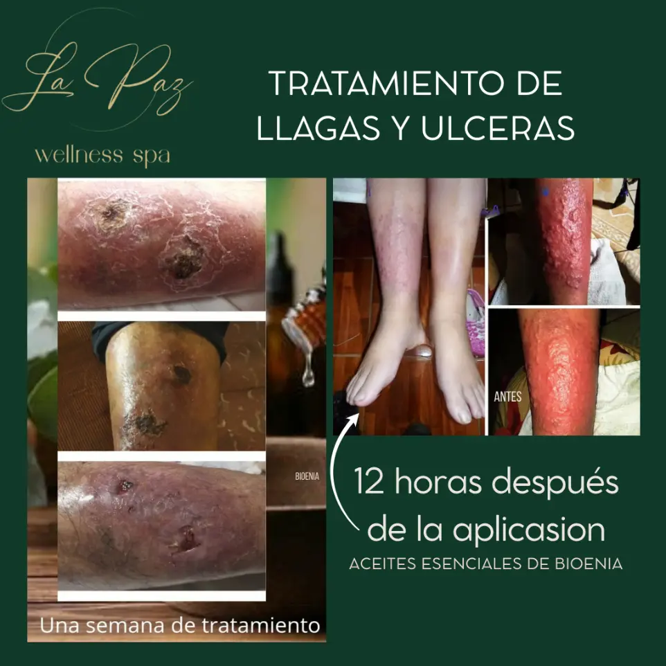​Tratamiento de Llagas