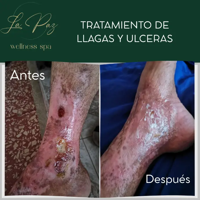 Tratamiento de Llagas y Úlceras